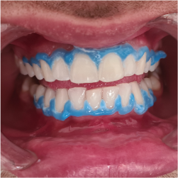 Избељивање зуба,17 јула 2023., Дуња стоматолог